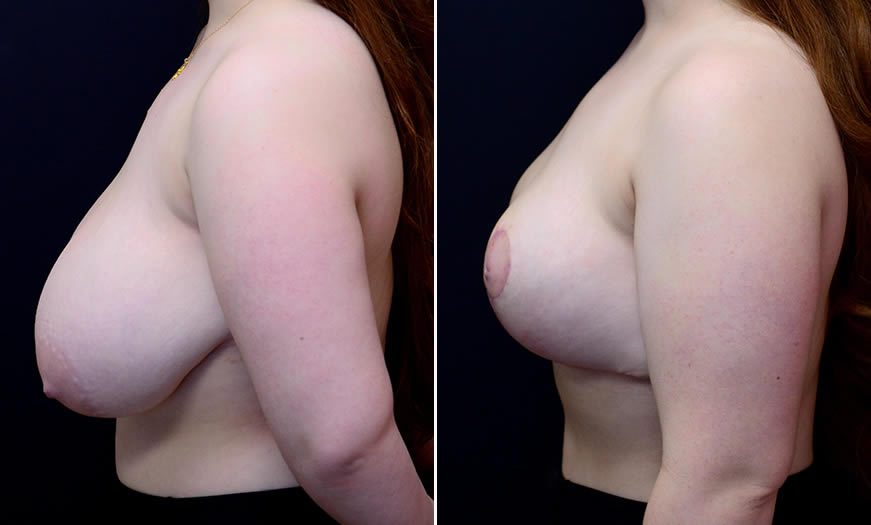 Before & After Breast Reduction Side Left