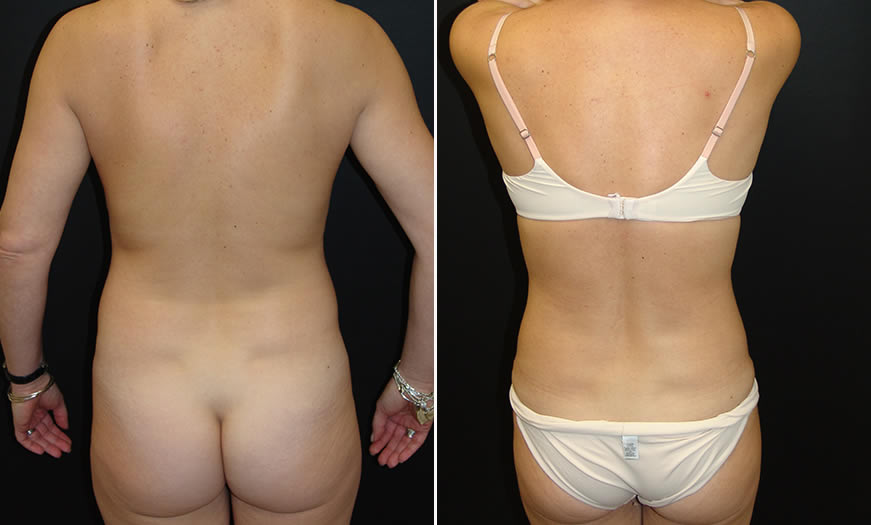 Before & After Core Abdominoplasty Back View