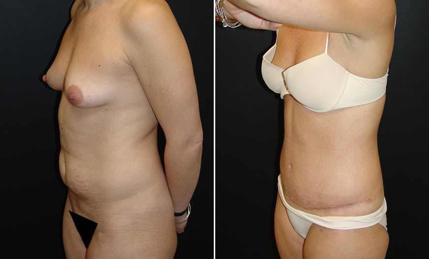 Before & After Core Abdominoplasty Quarter Left View