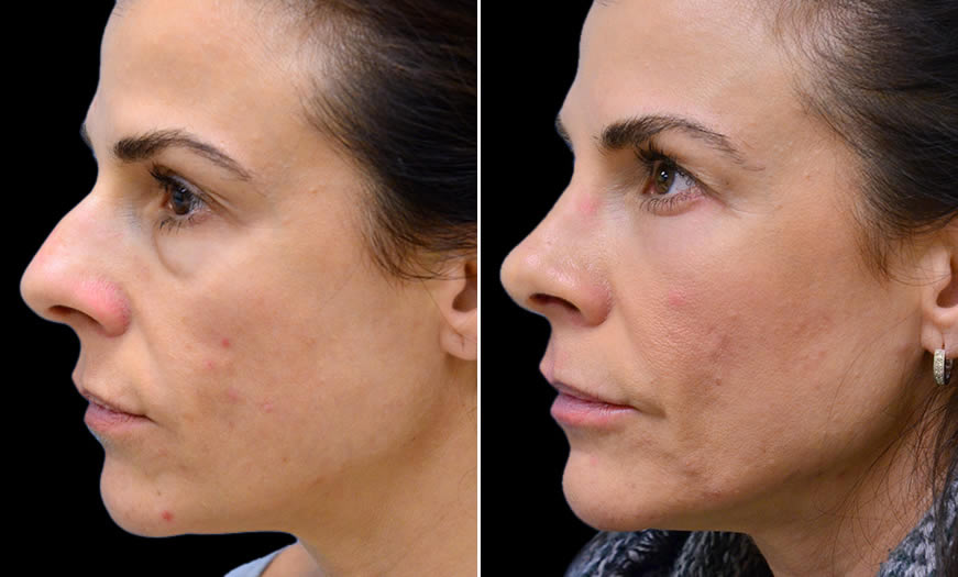 Before & After Cosmetic Fillers Side Left View