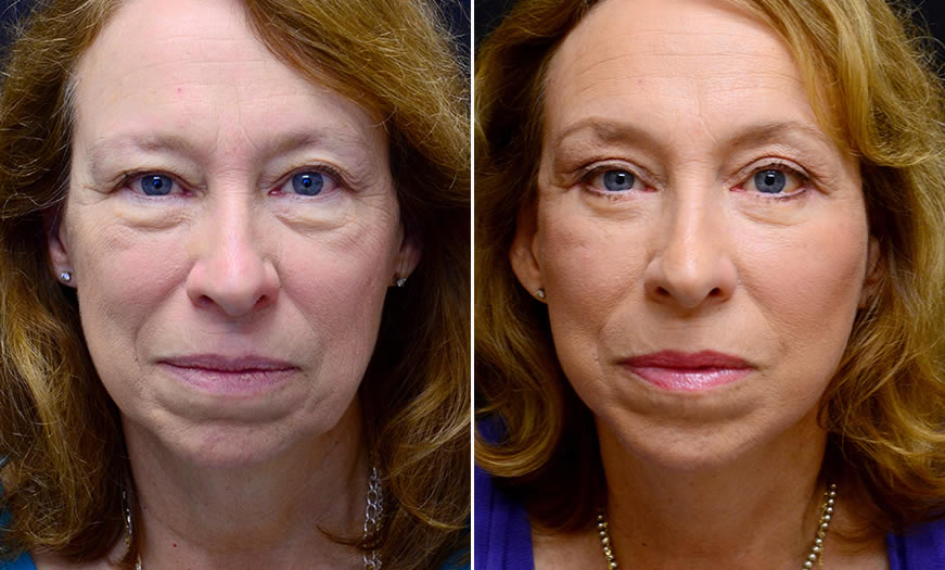 Before & After Face & Neck Lift Front View