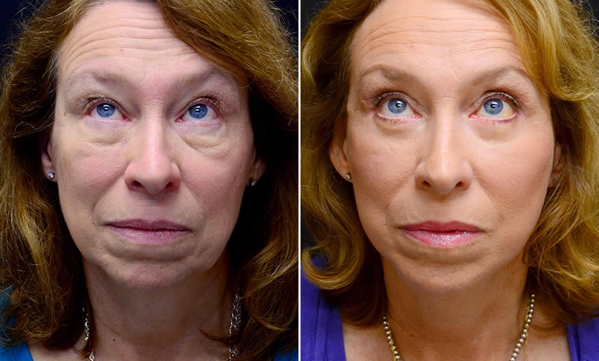 Before & After Face & Neck Lift Front View 2