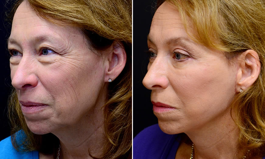 Before & After Face & Neck Lift Quarter Left View