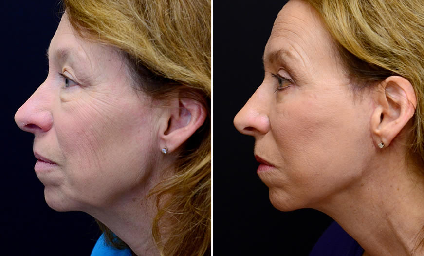 Before & After Face & Neck Lift Side Left View