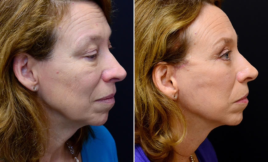 Before & After Face & Neck Lift Side Right View