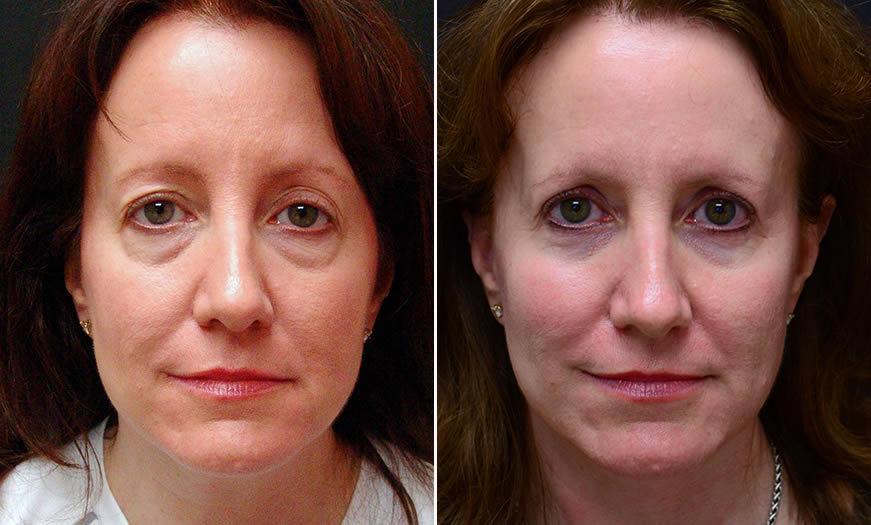 Before & After Face & Neck Lift Front View