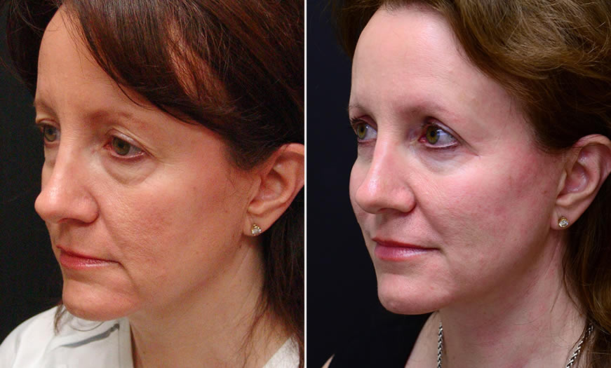 Before & After Face & Neck Lift Quarter Left View