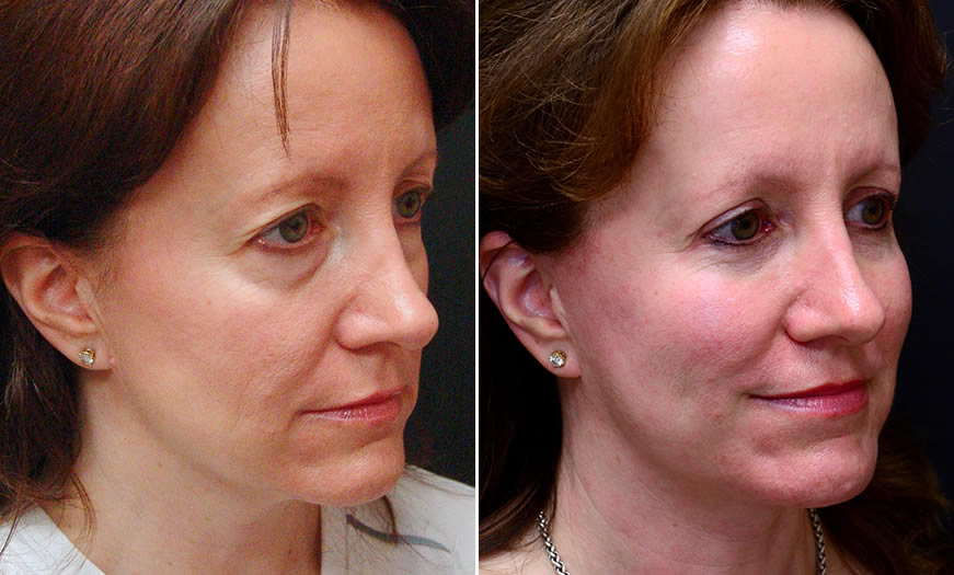 Before & After Face & Neck Lift Quarter Right View