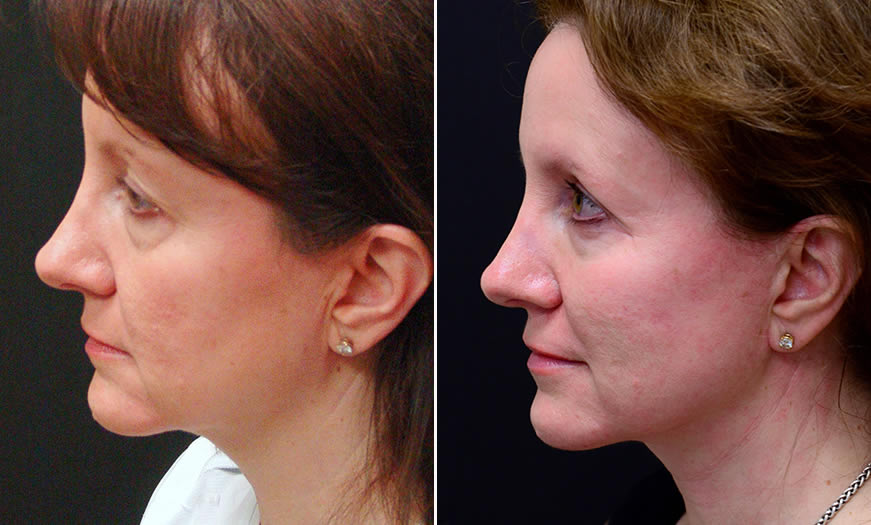 Before & After Face & Neck Lift Side Left View