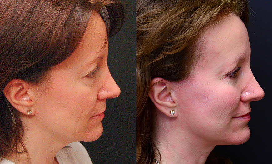 Before & After Face & Neck Lift Side Right View