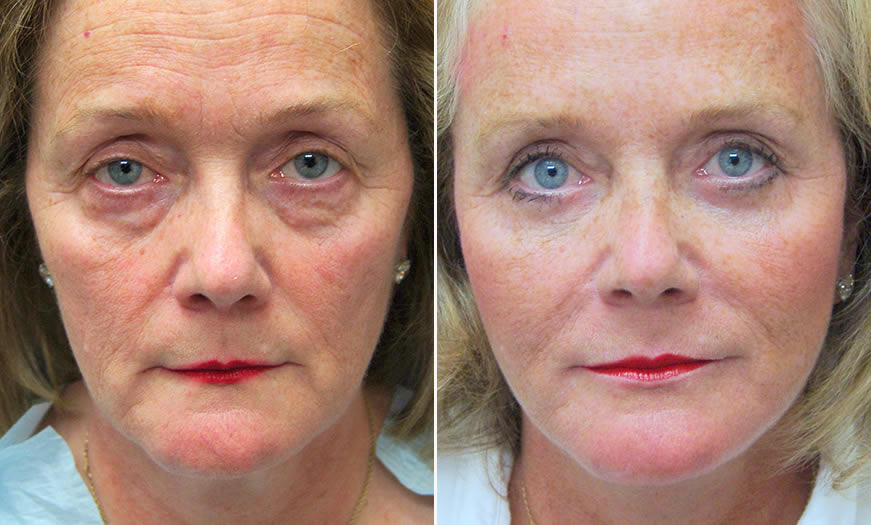 Before & After Face & Neck Lift Front View