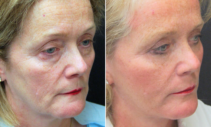 Before & After Face & Neck Lift Quarter Right View