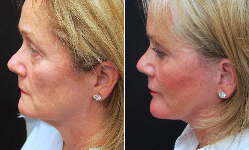 Before & After Face & Neck Lift Side Left View