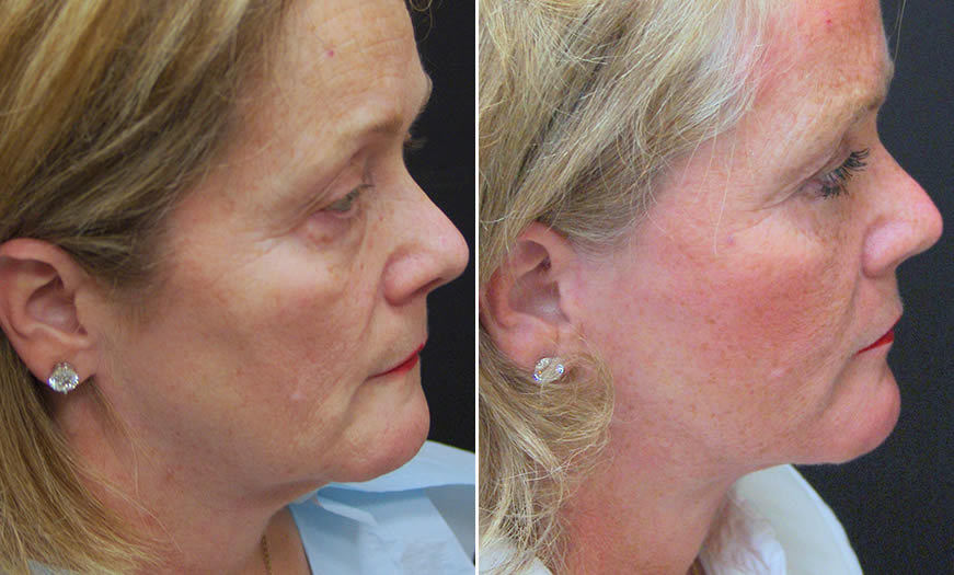 Before & After Face & Neck Lift Side Right View