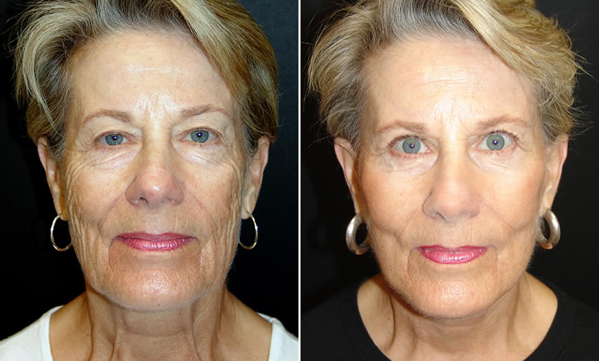 Before & After Face & Neck Lift Front View