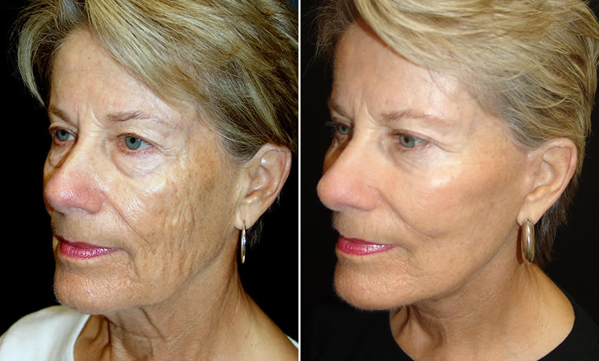 Before & After Face & Neck Lift Quarter Left View