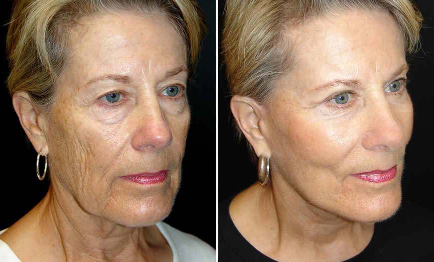 Before & After Face & Neck Lift Quarter Right View