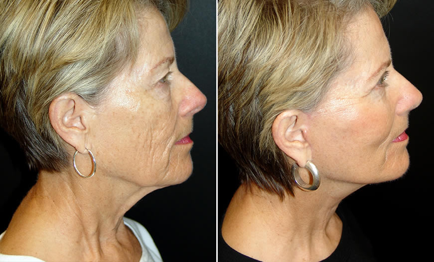 Before & After Face & Neck Lift Side Right View