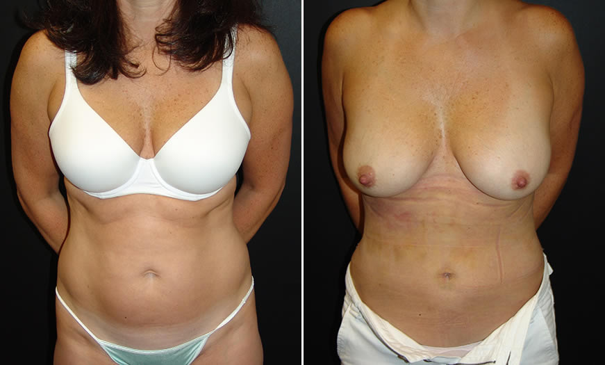 Before & After Liposuction Front View