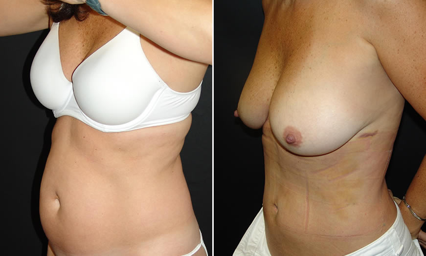Before & After Liposuction Quarter Left View