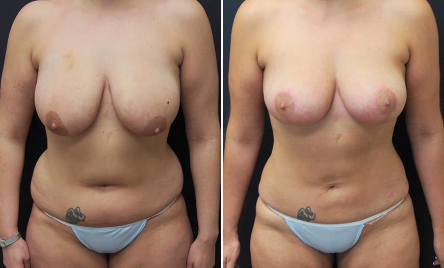 Before & After Liposuction Front View