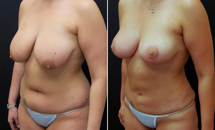 Before & After Liposuction Quarter Left View