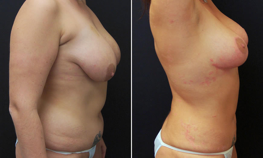 Before & After Liposuction Side Right View