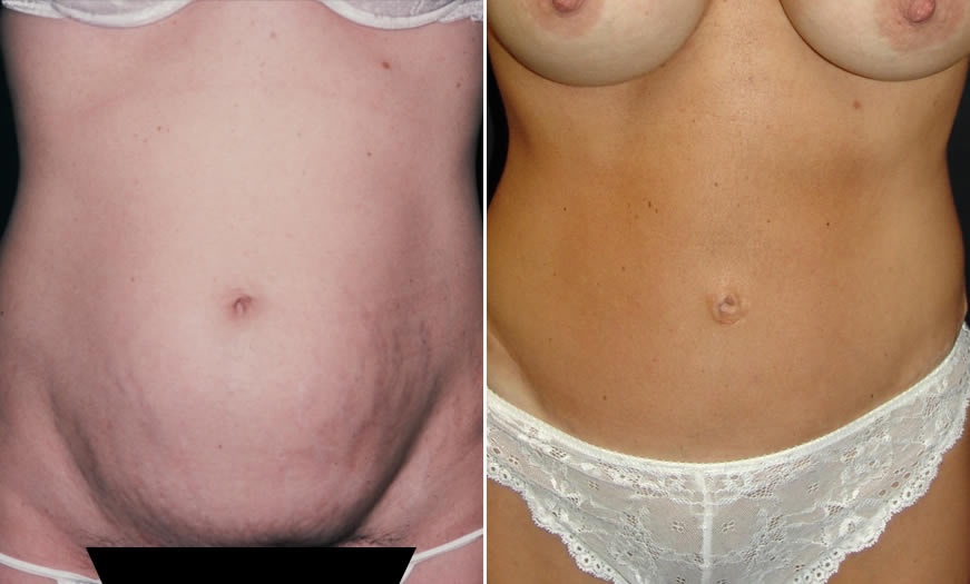 Before & After Core Abdominoplasty Front View