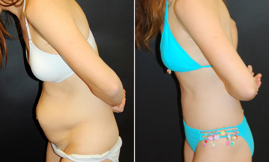 Before & After Tummy Tuck Side Left View