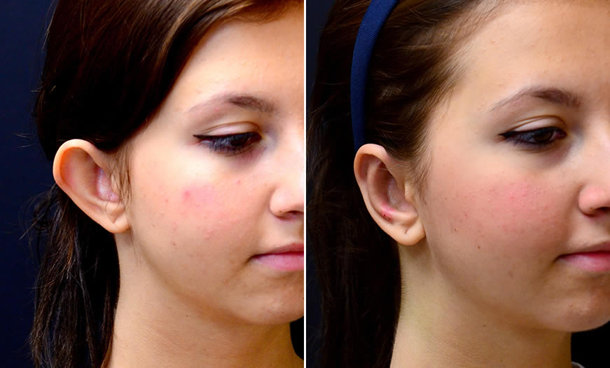 Before & After Otoplasty Quarter Right View
