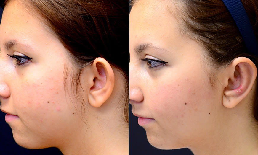 Before & After Otoplasty Side Left View