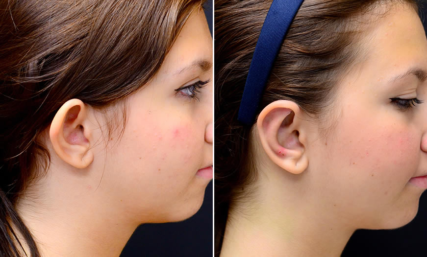 Before & After Otoplasty Side Right View