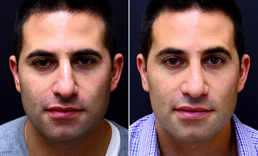 Before & After Rhinoplasty Front View