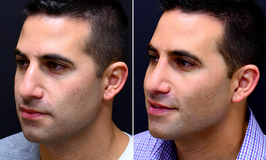 Before & After Rhinoplasty Quarter Left View