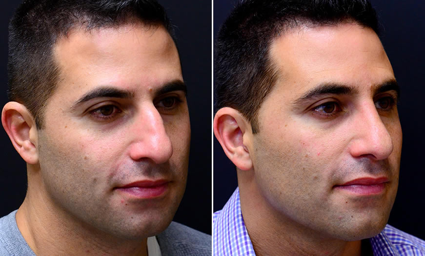 Before & After Rhinoplasty Quarter Right View