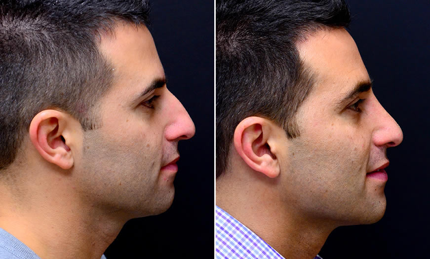 Before & After Rhinoplasty Side Right View