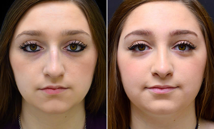 Before & After Rhinoplasty Front View