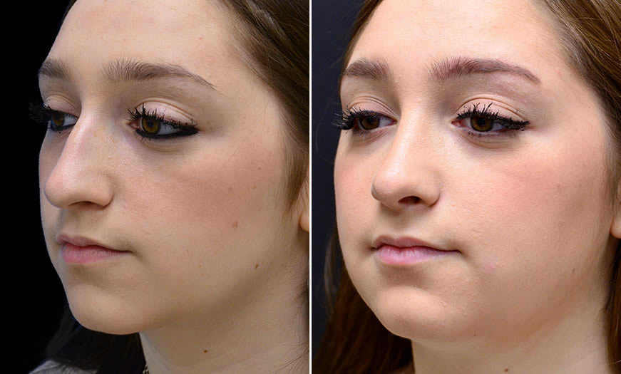 Before & After Rhinoplasty Quarter Left View