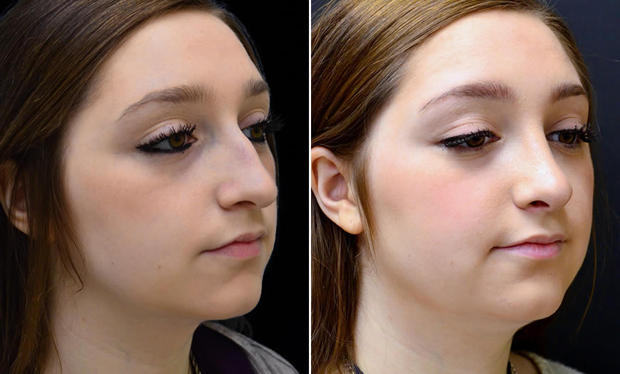 Before & After Rhinoplasty Quarter Right View