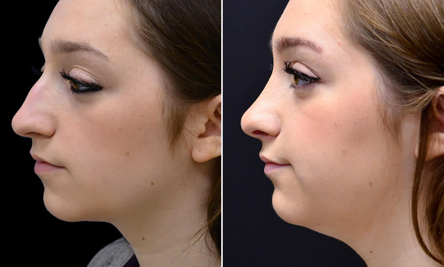 Before & After Rhinoplasty Side Left View