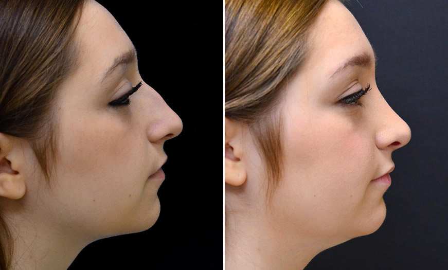 Before & After Rhinoplasty Side Right View