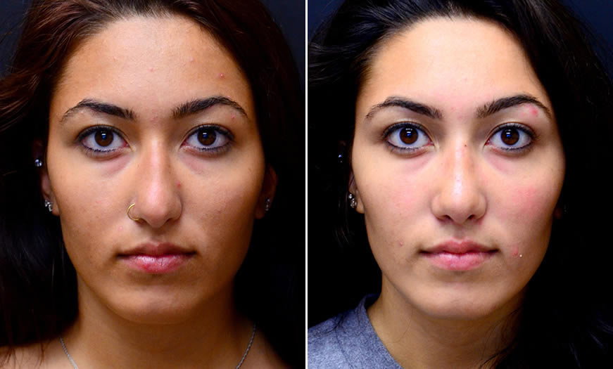 Before & After Rhinoplasty Front View