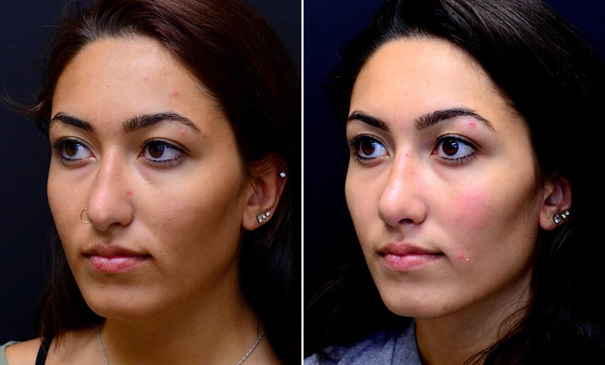 Before & After Rhinoplasty Quarter Left View