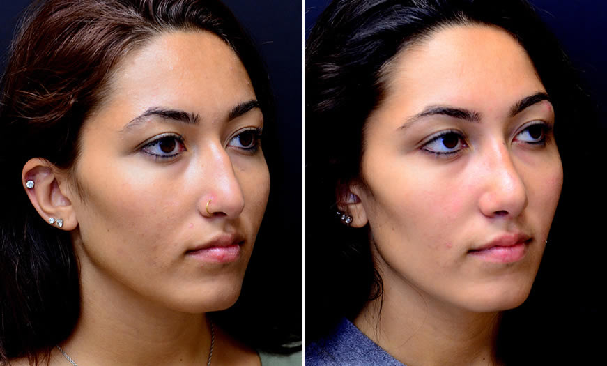 Before & After Rhinoplasty Quarter Right View