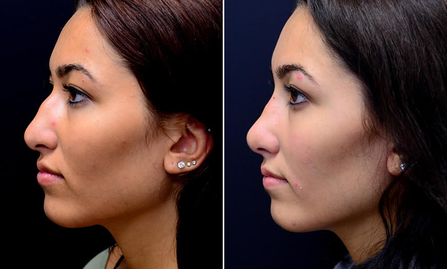 Before & After Rhinoplasty Side Left View