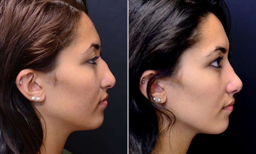 Before & After Rhinoplasty Side Right View