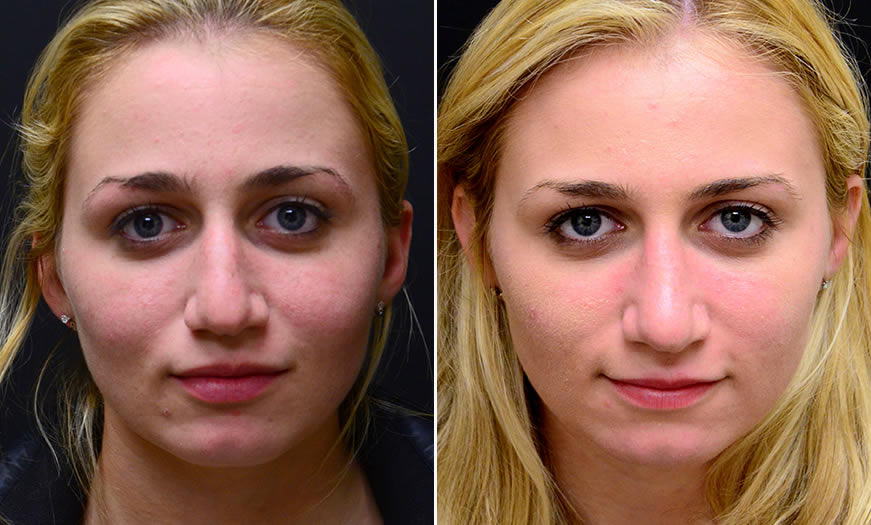 Before & After Rhinoplasty Front View