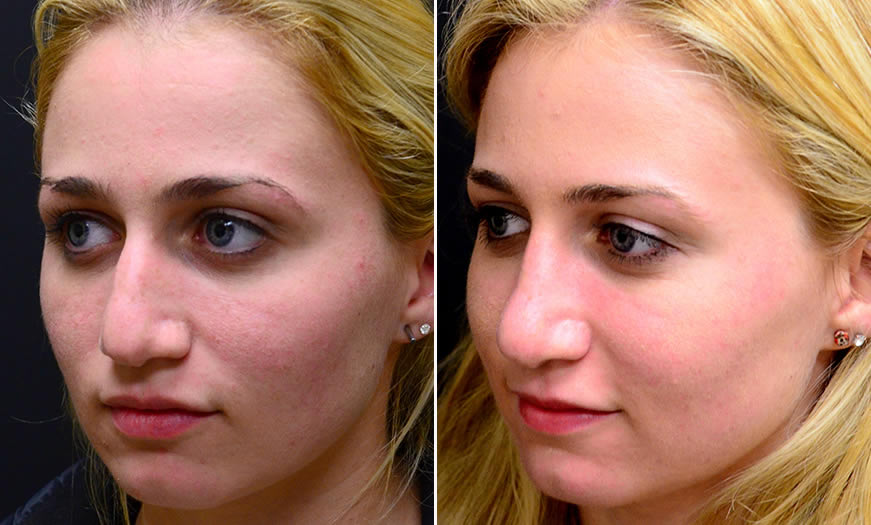 Before & After Rhinoplasty Quarter Left View