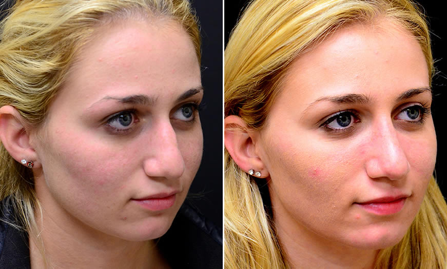 Before & After Rhinoplasty Quarter Right View