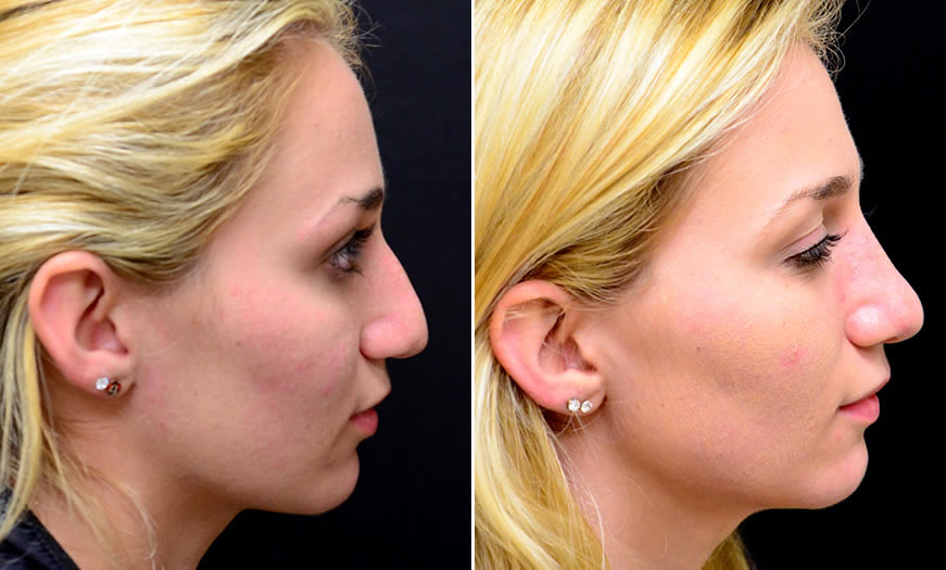 Before & After Rhinoplasty Side Right View